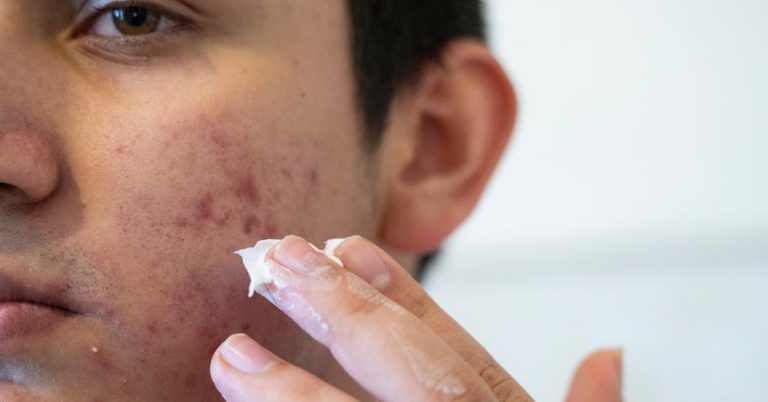 The Top Benefits of Choosing an Acne Specialist Over DIY Solutions