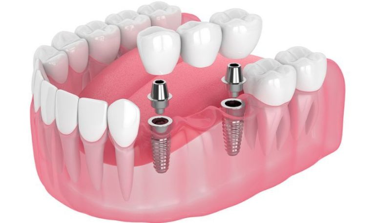 Enhance Your Confidence with Partial Implants and Dental Bridges