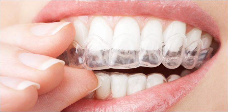Straighten Your Teeth Discreetly with Invisalign Experts in Mississauga